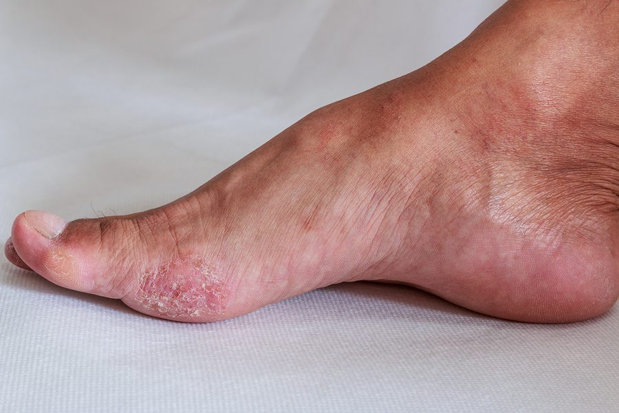 Facts About the 4 Most Common Fungal Infections and How to Treat Them