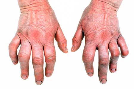 Arthritis of the Hand