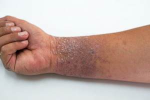 wrist with eczema