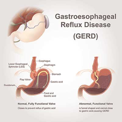 GERD - Acid reflux, heartburn, pain in the upper gut