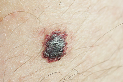 Photo of a Mole which is different from Melanoma
