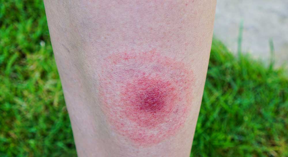 Signs of a Tick bite